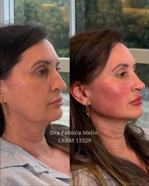 Antes e depois de reestruturação de mandíbula, vista lateral