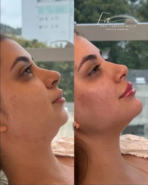 Antes e depois de perfil com lábios