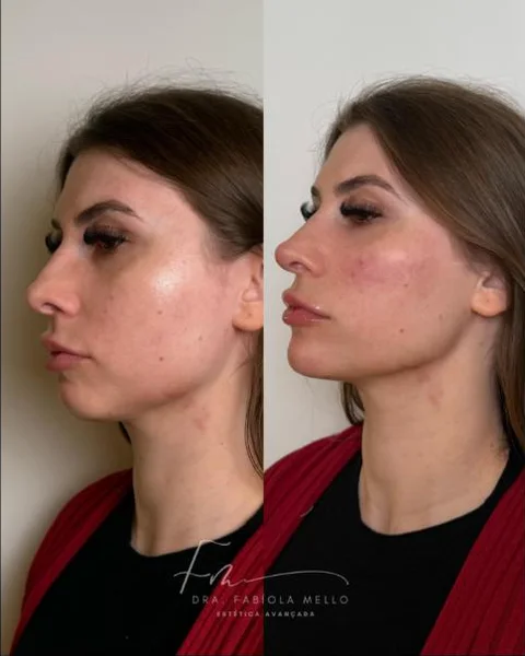 Antes e depois de queixo e perfil