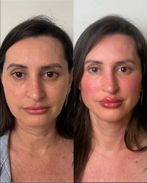Antes e depois de rejuvenescimento facial